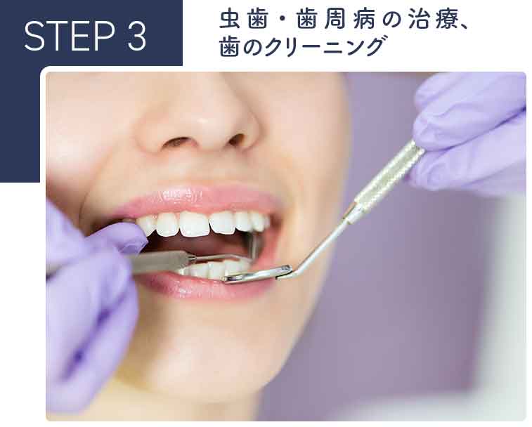 虫歯・歯周病の治療、歯のクリーニング