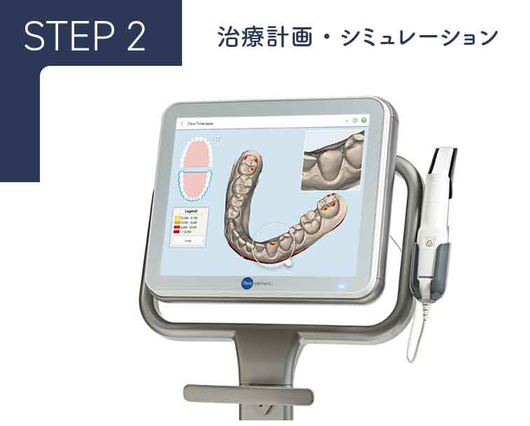 治療計画・シミュレーション