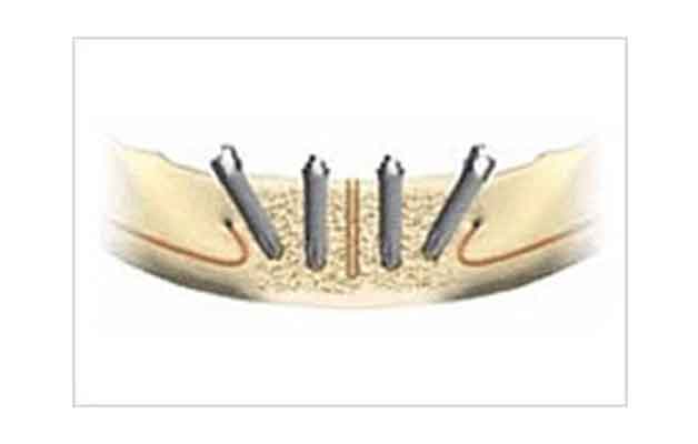 インプラント手術・仮歯の装着