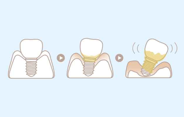 歯周病よりも進行が早いインプラント周囲炎