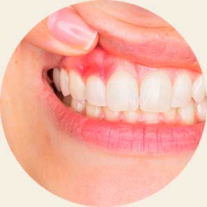 歯科金属が体に与える影響