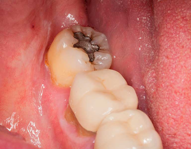 歯・歯茎の黒ずみ