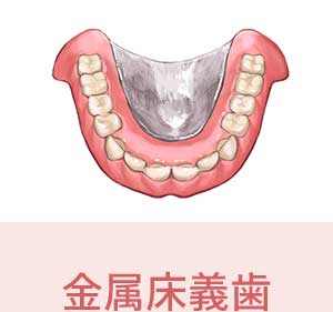 金属床義歯