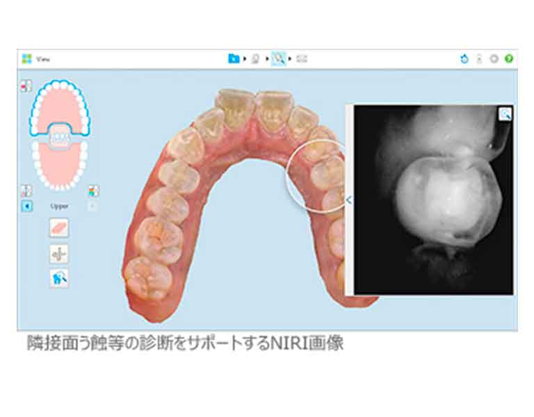 虫歯や歯石の可視化