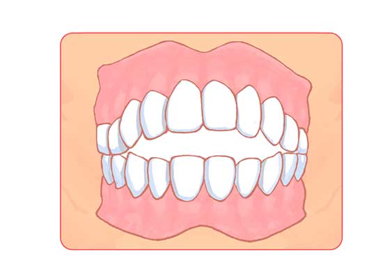前歯が噛み合わない