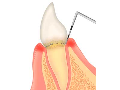 歯周精密検査